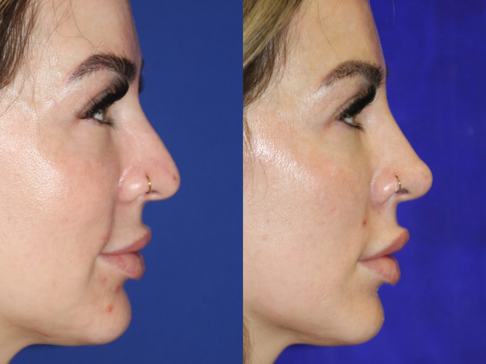 "Choosing the Right Surgeon for Ethnic Rhinoplasty in NYC: Key Considerations"